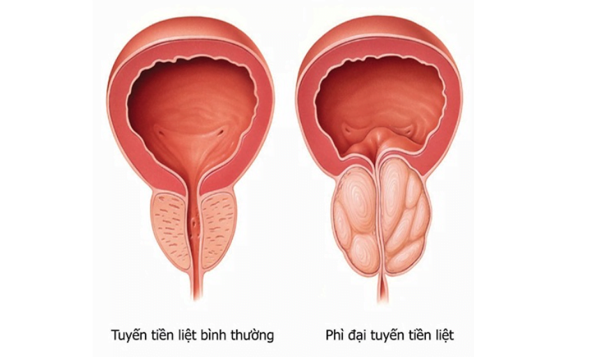 U xơ tiền liệt tuyến là gì?